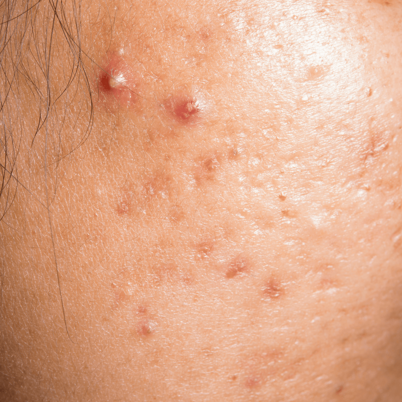 shop with Acne control